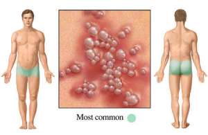 how-do-you-get-herpes